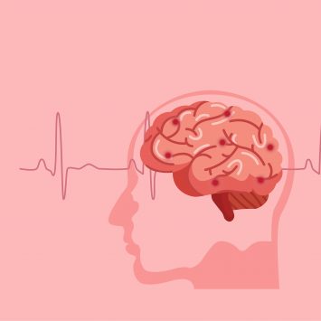 Tumores cerebrais e Radiocirurgia