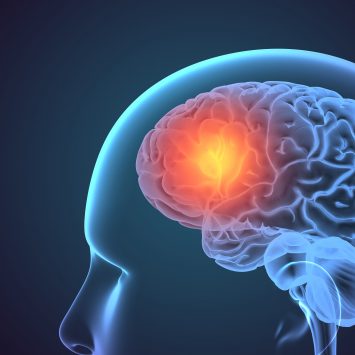 Tratamento para Metástases Cerebrais: Onde estamos?