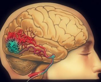 Radiocirurgia no tratamento de Malformações Arteriovenosas