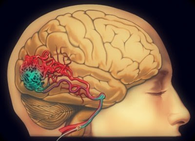 Radiocirurgia no tratamento de Malformações Arteriovenosas