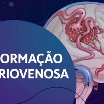 Malformação Arteriovenosa