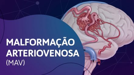 Malformação Arteriovenosa